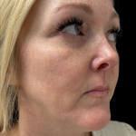 AVAVA Laser Before & After Patient #11381