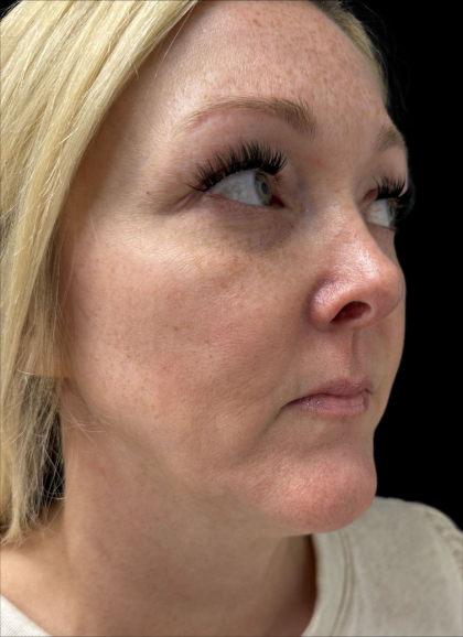 AVAVA Laser Before & After Patient #11381