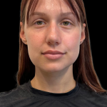Rhinoplasty Before & After Patient #11378