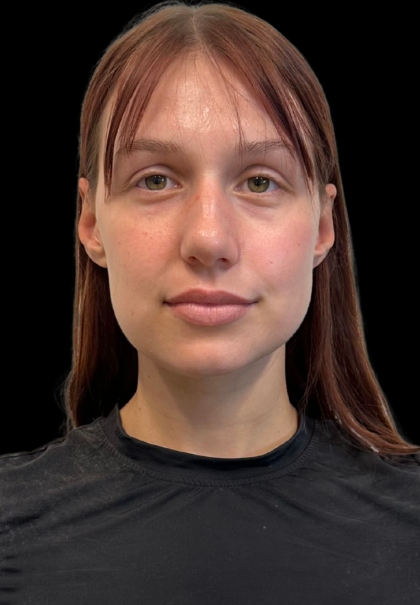 Rhinoplasty Before & After Patient #11378