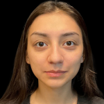 Rhinoplasty Before & After Patient #11380