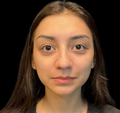 Rhinoplasty Before & After Patient #11380