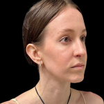 Rhinoplasty Before & After Patient #11379
