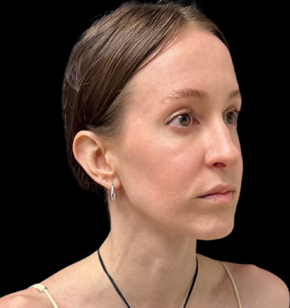 Rhinoplasty Before & After Patient #11379