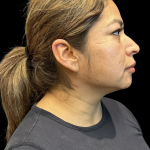 MyEllevate Before & After Patient #11374
