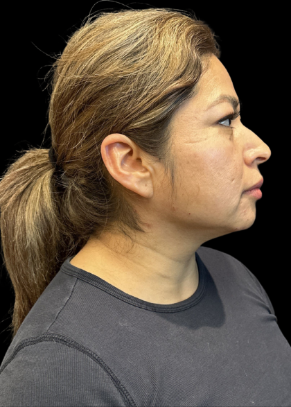 MyEllevate Before & After Patient #11374