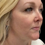AVAVA Laser Before & After Patient #11381