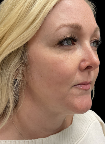 AVAVA Laser Before & After Patient #11381