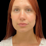 Rhinoplasty Before & After Patient #11378
