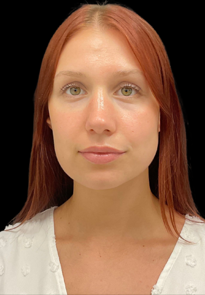 Rhinoplasty Before & After Patient #11378