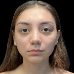 Rhinoplasty Before & After Patient #11380