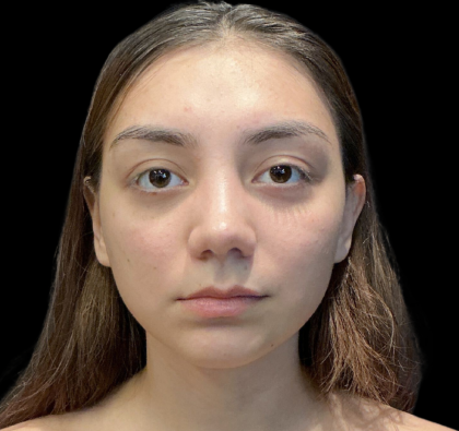 Rhinoplasty Before & After Patient #11380