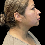MyEllevate Before & After Patient #11374