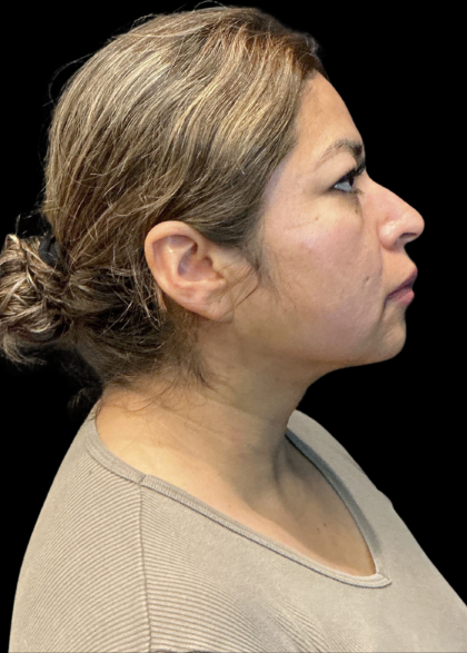 MyEllevate Before & After Patient #11374