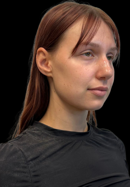 Rhinoplasty Before & After Patient #11378