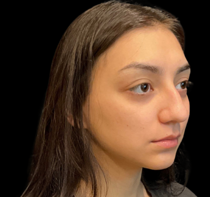 Rhinoplasty Before & After Patient #11380