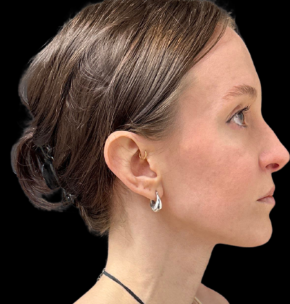 Rhinoplasty Before & After Patient #11379