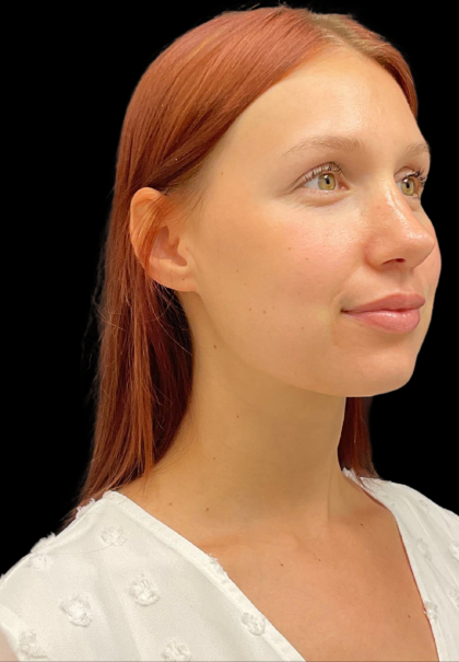 Rhinoplasty Before & After Patient #11378