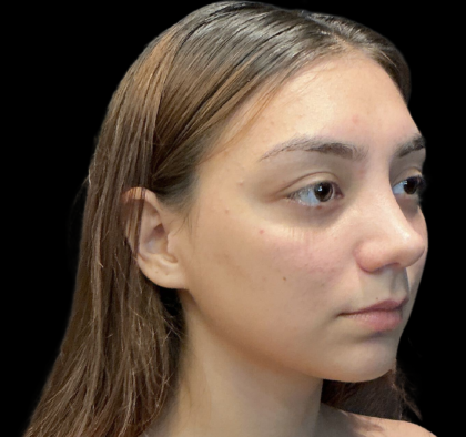 Rhinoplasty Before & After Patient #11380