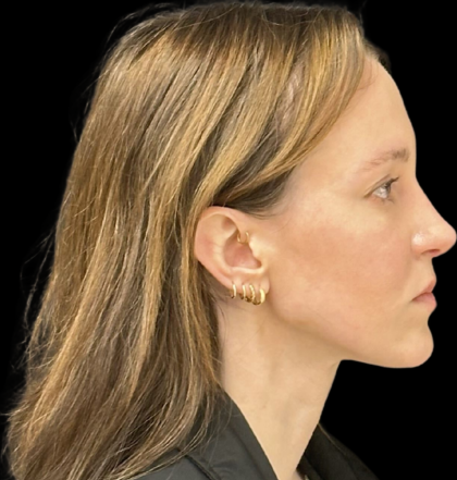 Rhinoplasty Before & After Patient #11379