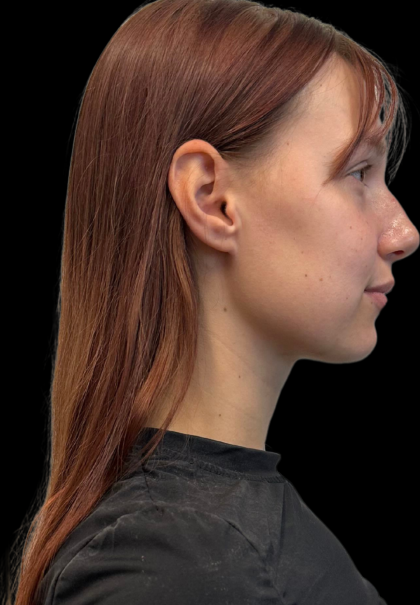 Rhinoplasty Before & After Patient #11378