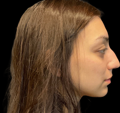 Rhinoplasty Before & After Patient #11380