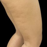 Aveli (Cellulite Removal) Before & After Patient #11520