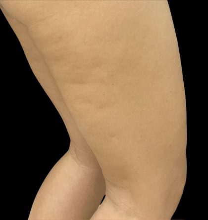 Aveli (Cellulite Removal) Before & After Patient #11520