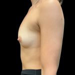 Breast Augmentation Before & After Patient #11530