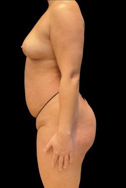 Brazilian Butt Lift Before & After Patient #11541