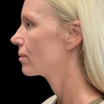 Sofwave Before & After Patient #11567