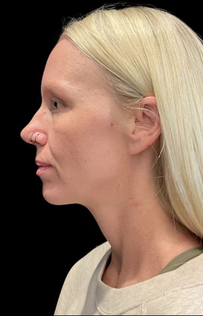 Sofwave Before & After Patient #11567