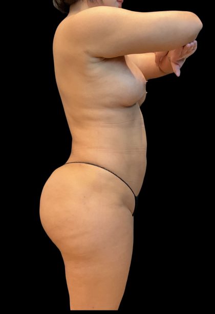 Brazilian Butt Lift Before & After Patient #11541