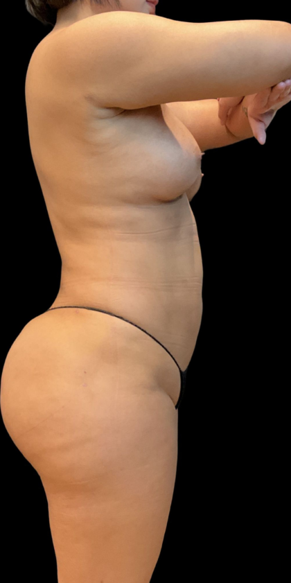 Brazilian Butt Lift Before & After Patient #11591