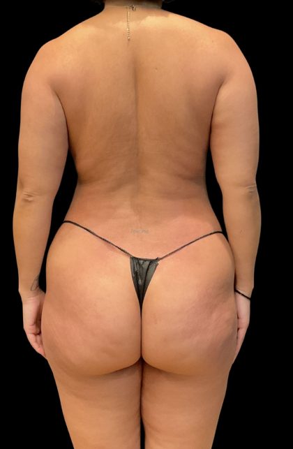 Brazilian Butt Lift Before & After Patient #11541