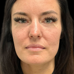 AVAVA Laser Before & After Patient #11573