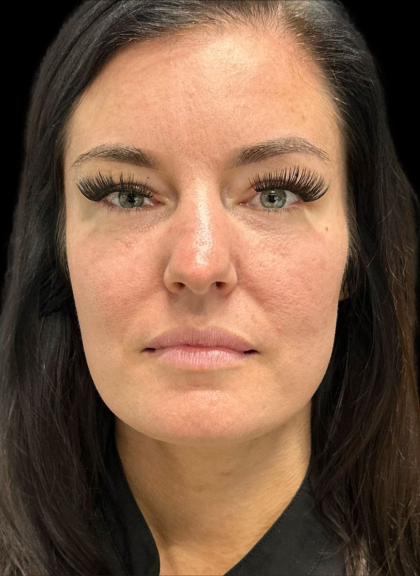 AVAVA Laser Before & After Patient #11573