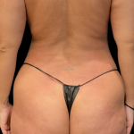 Brazilian Butt Lift Before & After Patient #11591