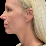Sculptra Before & After Patient #11581
