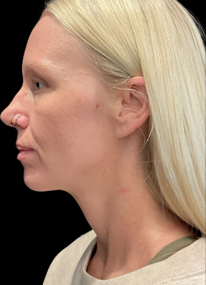 Sculptra Before & After Patient #11581