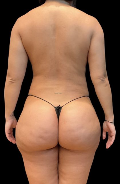 Brazilian Butt Lift Before & After Patient #11541