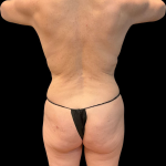Rib Repositioning Before & After Patient #11578