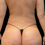 Brazilian Butt Lift Before & After Patient #11591