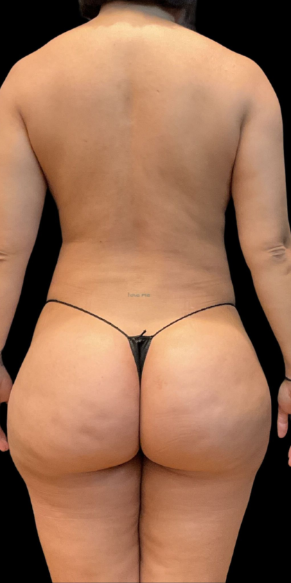 Brazilian Butt Lift Before & After Patient #11591
