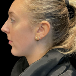 Chin Filler Before & After Patient #11586