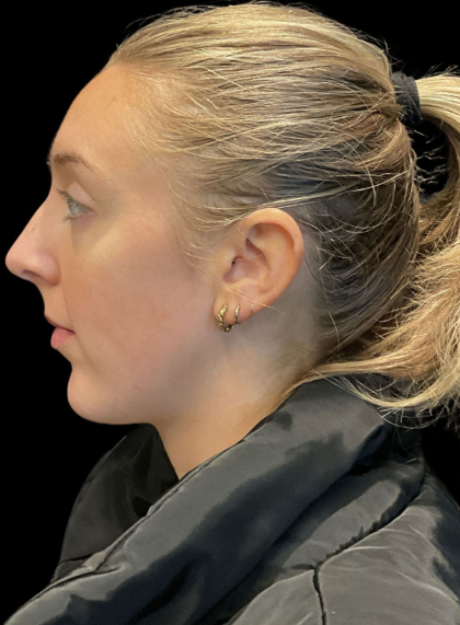 Chin Filler Before & After Patient #11586