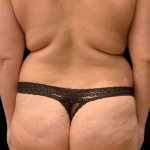 Brazilian Butt Lift Before & After Patient #11579