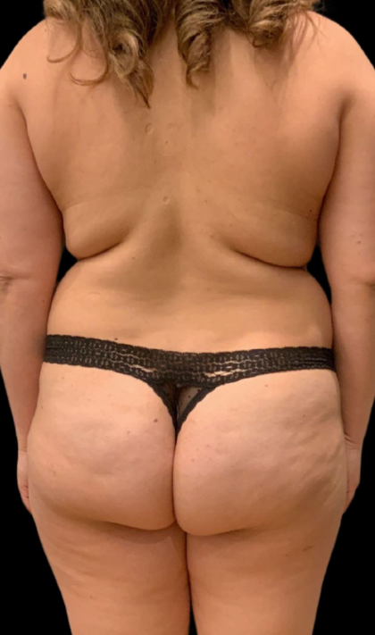 Brazilian Butt Lift Before & After Patient #11579