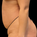 Brazilian Butt Lift Before & After Patient #11591