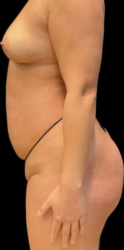 Brazilian Butt Lift Before & After Patient #11591